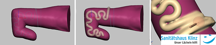 Mit Hilfe des Finger-Scans konnte eine sehr genaue Orthese erstellt werden.